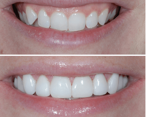 Gum Lift surgery Gum Lift surgery