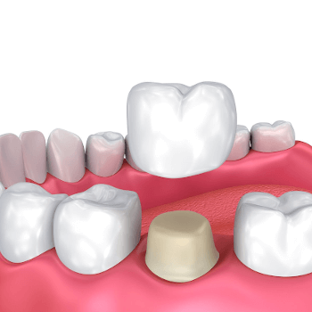 Crowns and Bridges Post Op Crowns and Bridges Post Op